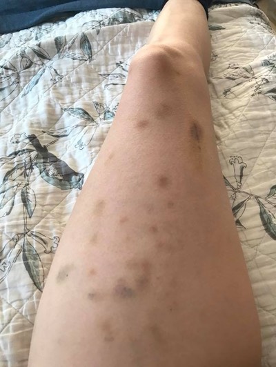 Babesia 