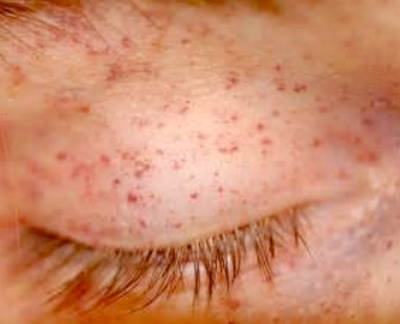 Petechiae over the eyelids photo images