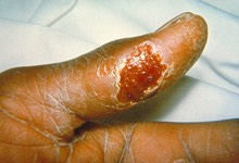 tularemia_ulcer